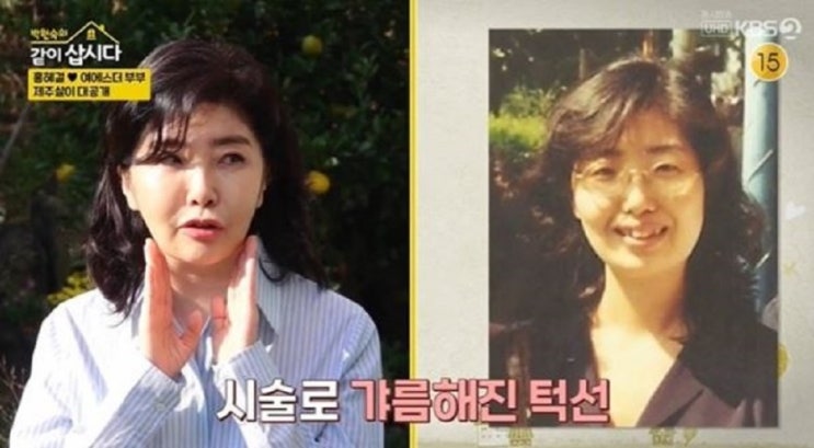 ‘성형논란’ 여에스더, “칼 안 대고 ‘이것’만 했다" 무슨 시술 받았을까? ‘성형논란’ 여에스더, “칼 안 대고 ‘이것’만 했다" 무슨 시술 받았을까?