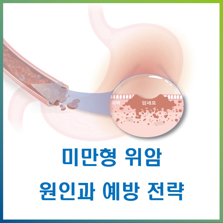  침묵 속의 위협, 미만형 위암 – 예방을 위한 고위험군 선별법, 위건강토탈케어 [내시경 + GastroPanel 위정밀혈액 세트검사]