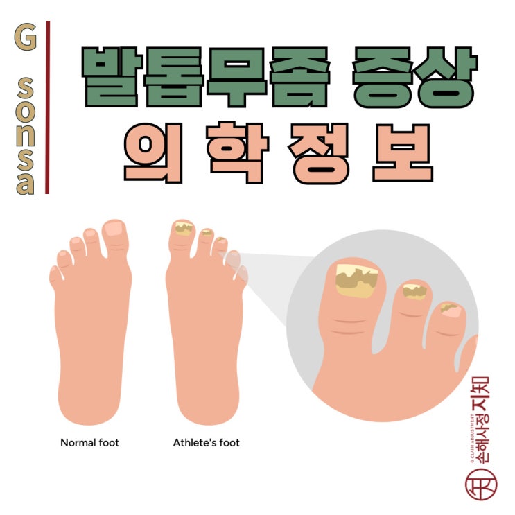  엄마, 발톱 무좀 증상 이렇게 시작된대요! - [의학정보, AlDa]