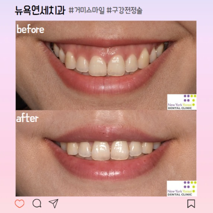 웃을 때 잇몸 보임 거미스마일 수술
