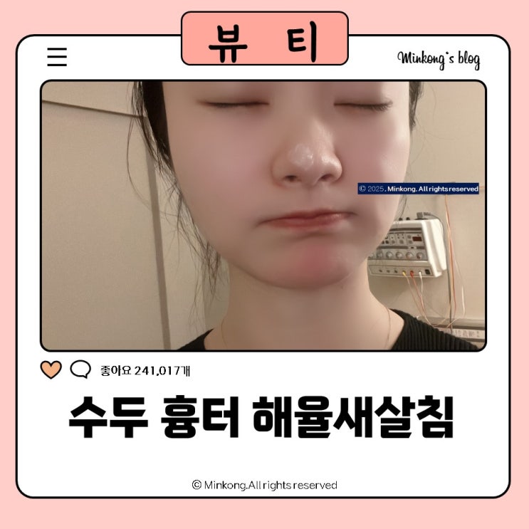  안산여드름흉터 새살침 오름테라피 후기: 내돈내산 솔직 리뷰