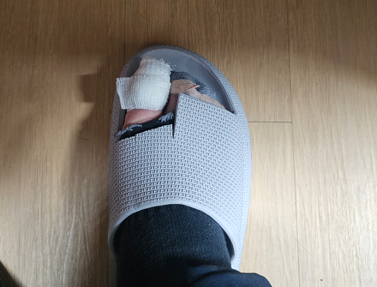  발톱 들렸을 때 발톱 빠졌을 때_1일차