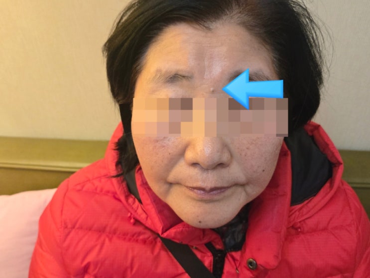 내돈내산 튀어나온 점 제거 얼굴 큰점 빼는법 큰점제거 내돈내산 튀어나온 점 제거 얼굴 큰점 빼는법 큰점제거