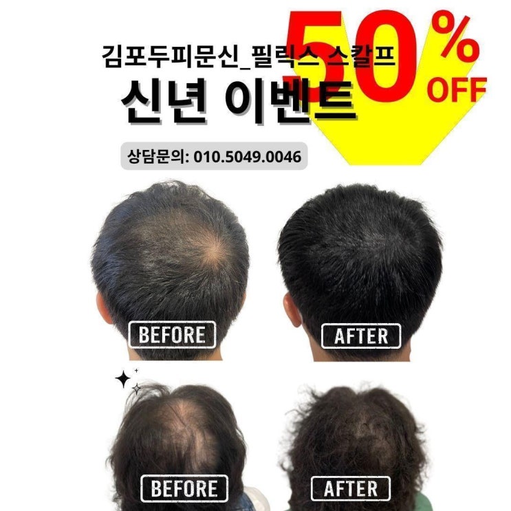  검단두피문신과 탈모커버