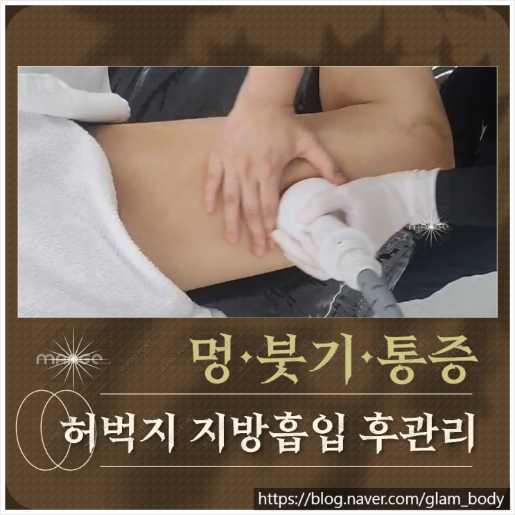  허벅지 지방흡입 후관리 멍 붓기 관리후기