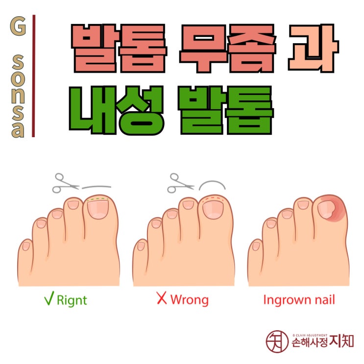  발톱무좀이 내성발톱을 만든다고? 작은 문제, 큰 결과 - [의학정보, AlDa]