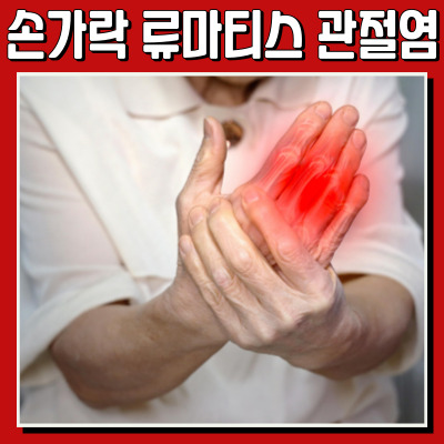 아침의 뻣뻣함, 손가락 류마티스 관절염일까?