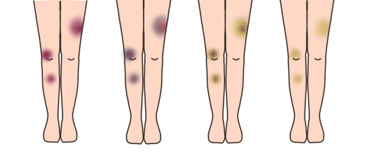  하지정맥류 멍 다리에 멍과 쉽게 구분하는 방법