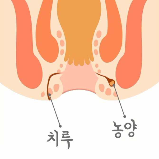 치루 수술 후 관리방법 알아보기
