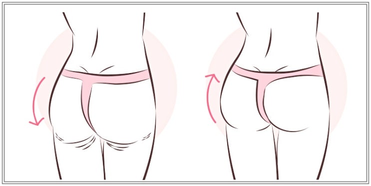  골반지방이식을 고민하는 당신에게! "이것"은 어떠세요?