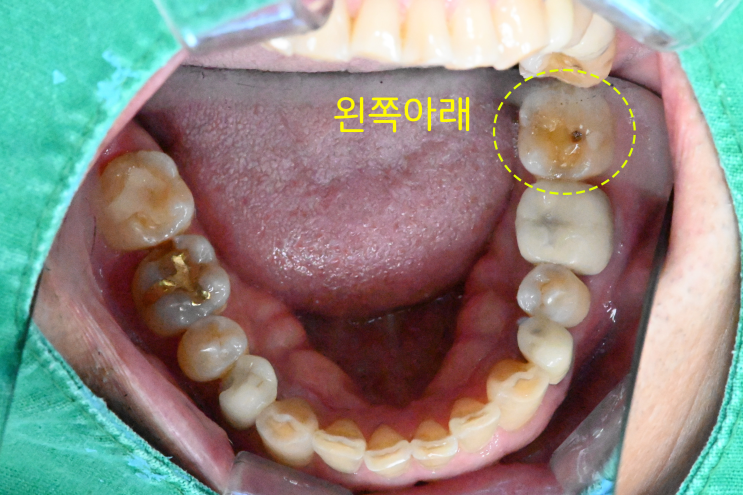  금광동치과, 금이간치아(치아크랙) 신경치료하고 씌운 케이스