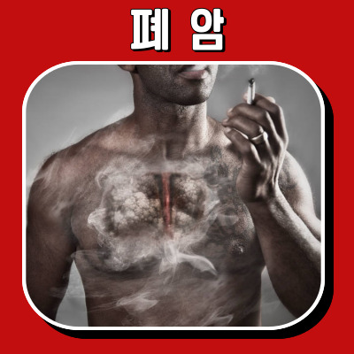 폐암의 조기 발견을 위한 모든 것