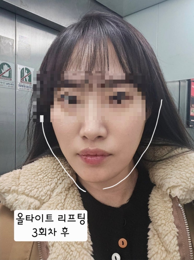  수원광교피부과 올타이트리프팅 가격 후기, 3회차 쳐진얼굴에 효과적