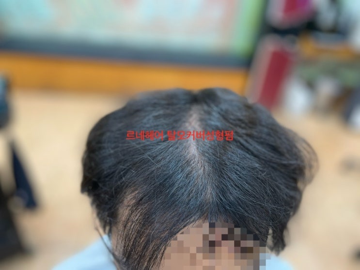  남자엠자탈모정수리탈모 가르마탈모커버도전 가르마탈모커버성형펌 부산사상르네시떼6층미용실/ 명지대동김해하단다대녹산화명주례감전괘법강서구연산연제망미수영해운대센텀광안민락용호수비정관기장울산