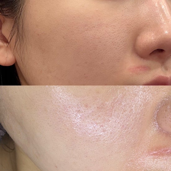 리쥬란힐러 후기(4cc) + 쥬베룩 2cc 조합, 7일차까지 변화 솔직 리뷰 : 건조·속당김 해결된 스킨부스터 효과