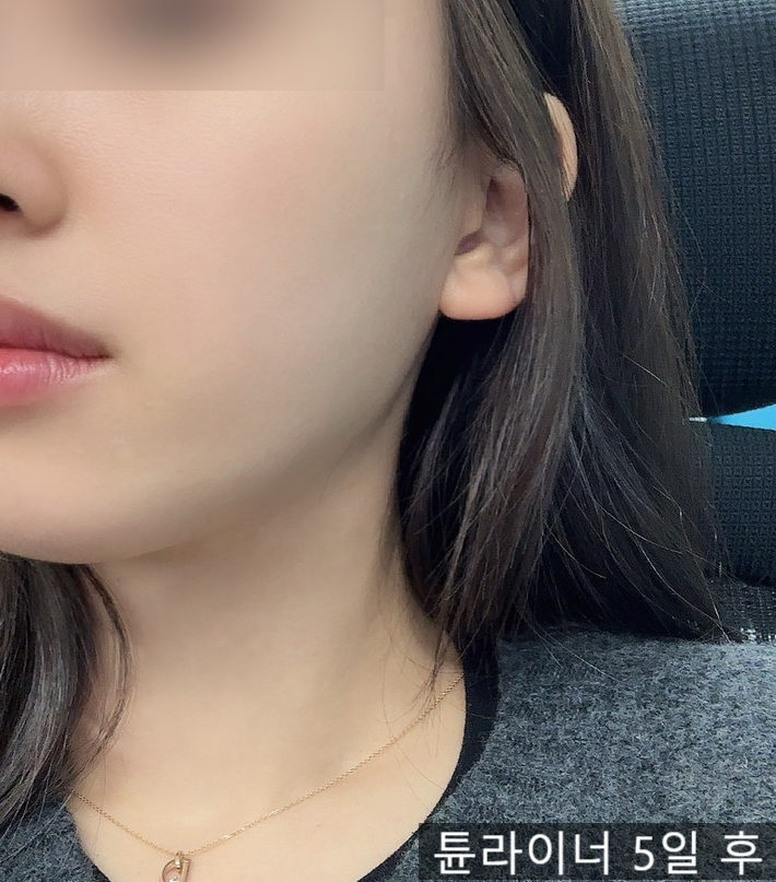  피부과에서 튠라이너 받았는데, 이중턱에 효과 있을까?
