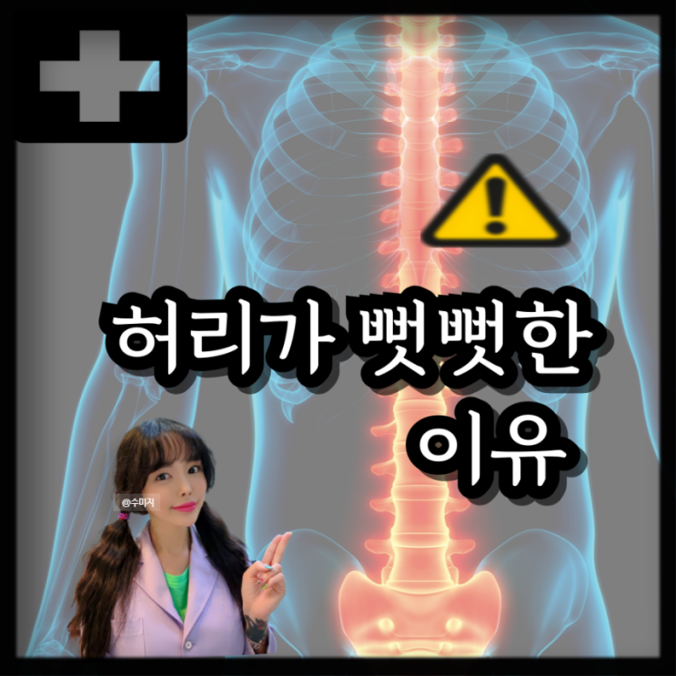  강직성 척추염 증상 원인 검사 강직성 척추염 치료