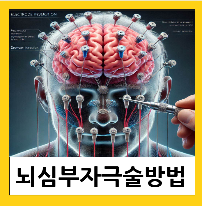 파킨슨병 뇌심부 자극술 대상 방법 비용