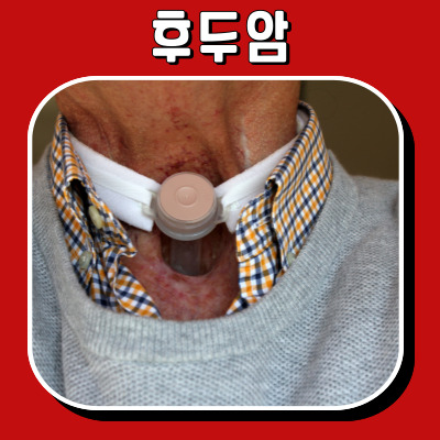 후두 암의 초기 증상과 치료법: 알아야 할 모든 것