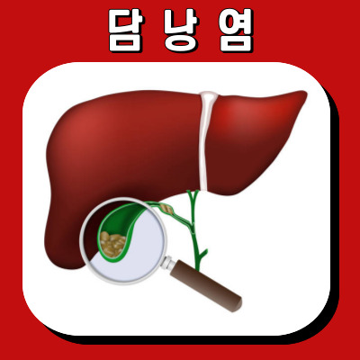담낭염의 증상과 진단: 당신이 알아야 할 정보