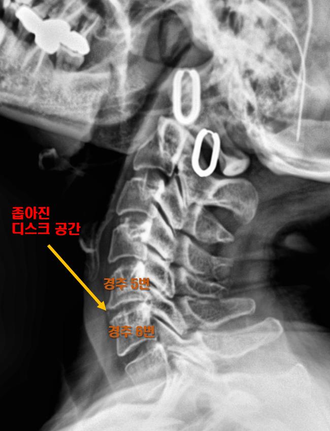  광주 목디스크, 3번이나 받은 신경차단술 통증이 점점 심해져요