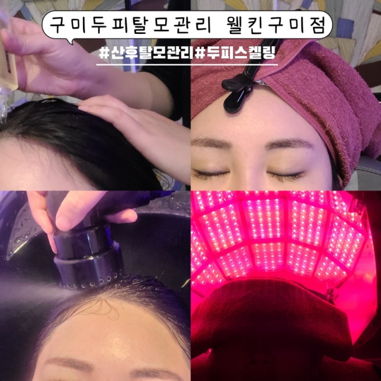 구미두피탈모관리 웰킨구미점 시원한 두피스켈링 후기