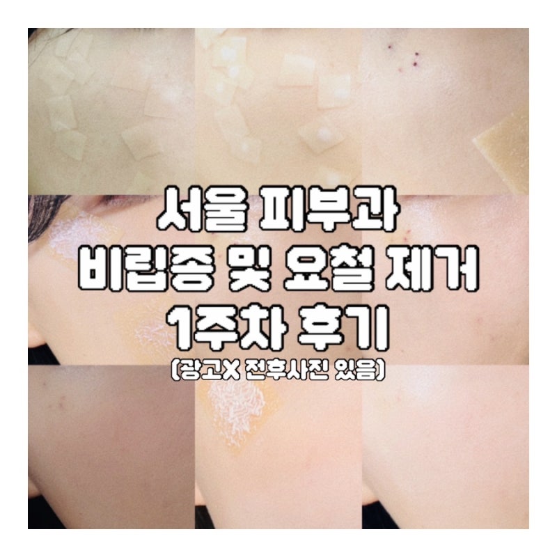 서울 피부과 비립종 레이저 제거 솔직후기 및 관리꿀팁(1주차)