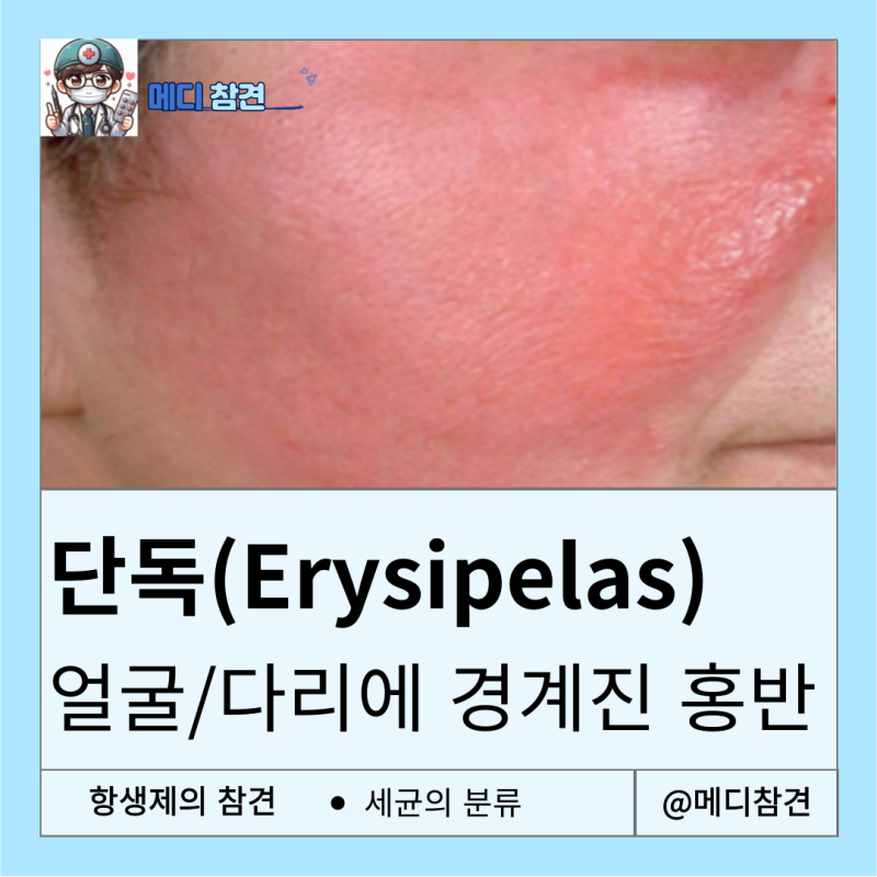 A군 연쇄상구균 Streptococcus pyogenes Erysipelas