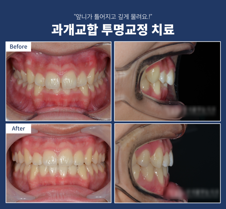 과개교합(앞니 깊게 물리는 교합) 치료하는 방법, 투명교정(인비절라인)으로 쉽게 치료하기 과개교합(앞니 깊게 물리는 교합) 치료하는 방법, 투명교정(인비절라인)으로 쉽게 치료하기