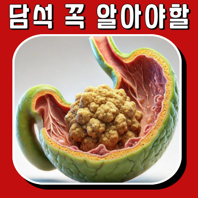담석의 종류와 꼭 알아야 할 위험 요인