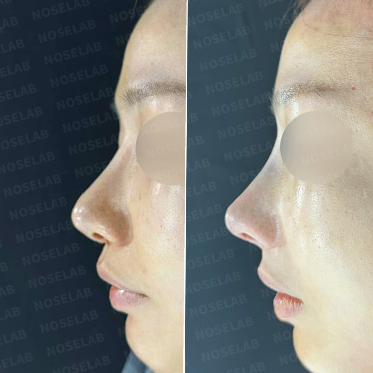  휘어진 코와 돌출입 개선 - 자가늑연골 재건 실제 후기 [노즈랩의원]