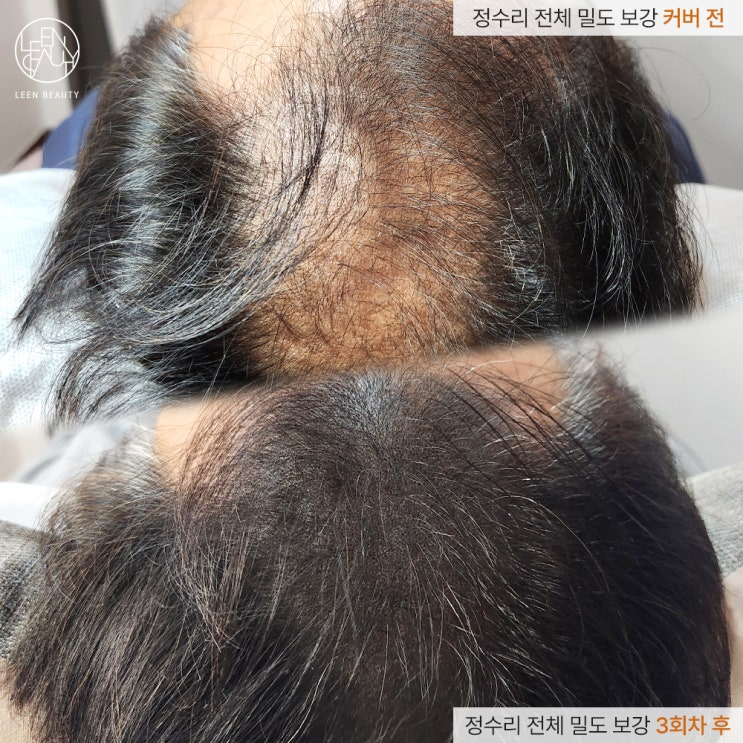  반영구 탈모두피문신 관리법 및 효과