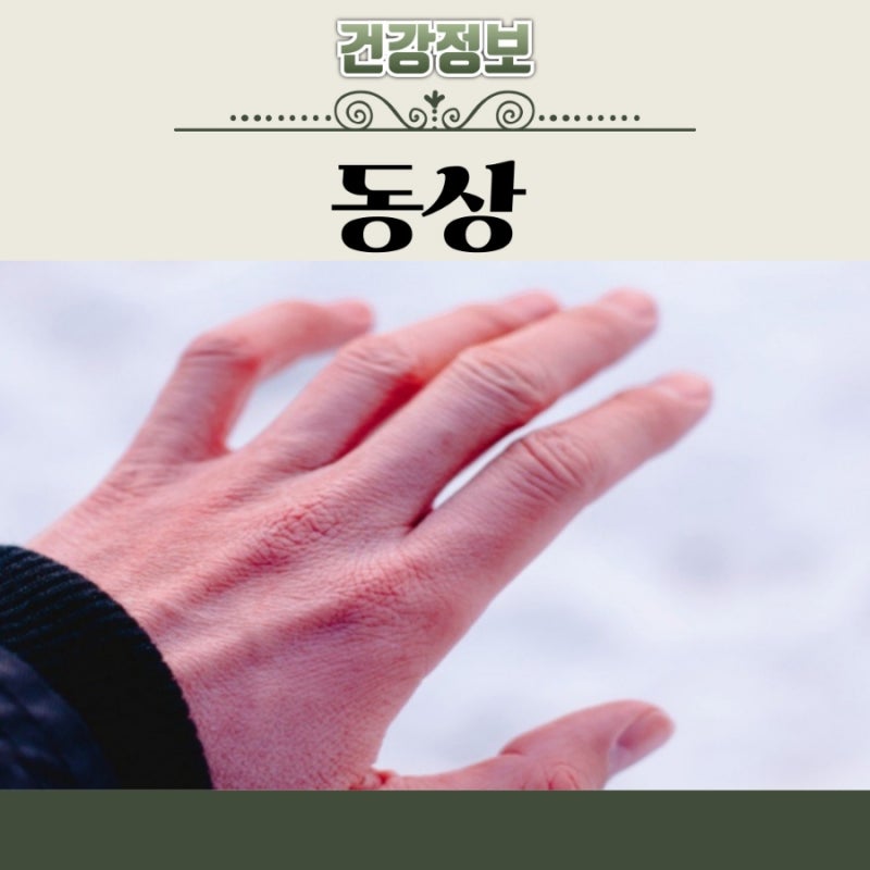 발 손가락 발가락 동상 증상 치료 연고 원인