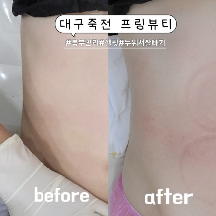 대구 죽전 다이어트 프링뷰티에서 셀핏 복부관리받았어요