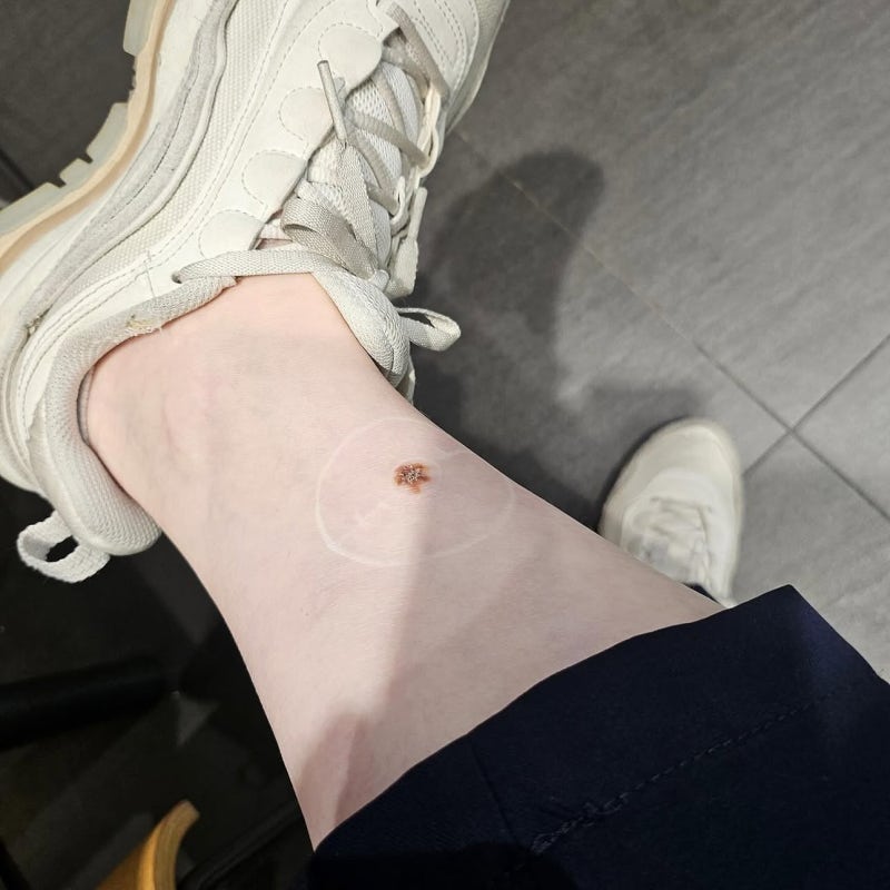 악성 흑색종 피부암 확정부터 수술까지 자세한 후기