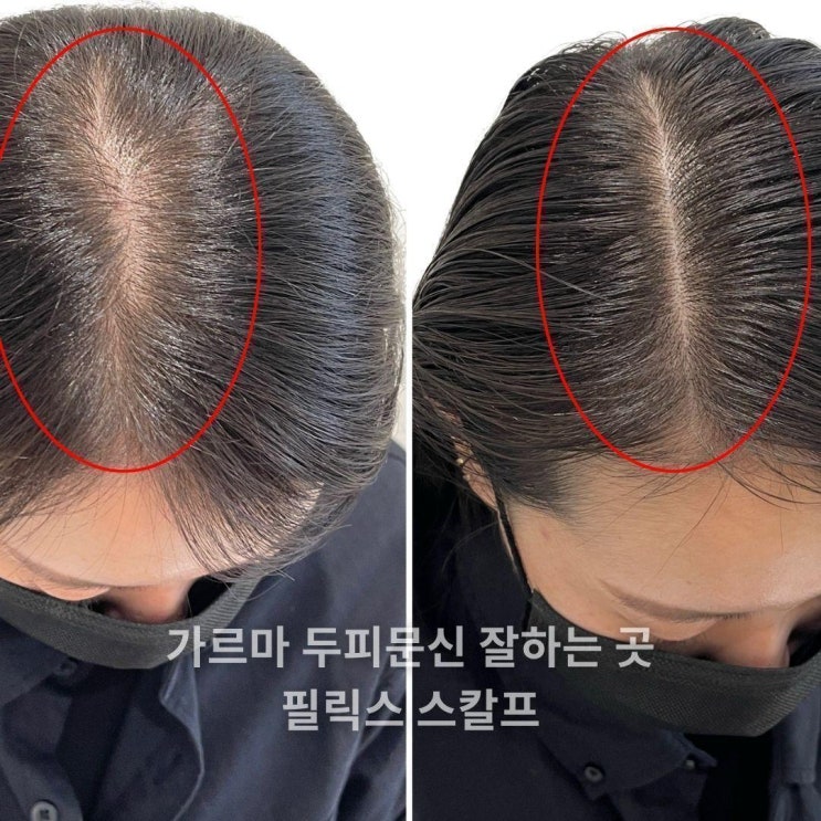  김포두피문신교육 탈모 고민으로 시작하여 두피문신 창업까지 하게된 사연!