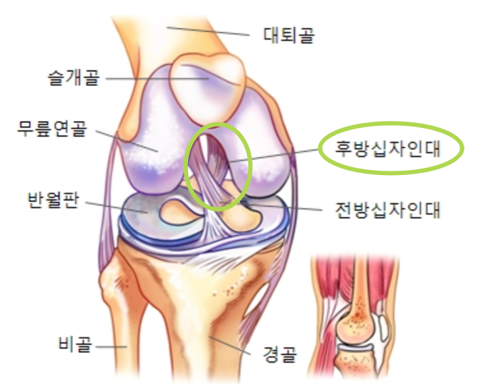[스포츠 손상] 후방 십자인대 손상이란? (원인, 증상, 예방)