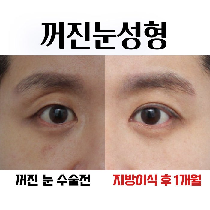 아이홀지방이식 꺼짐을 울퉁불퉁하지 않게 채워줄려면