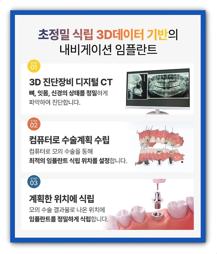  최소절개 임플란트 네비게이션임플란트의 장점