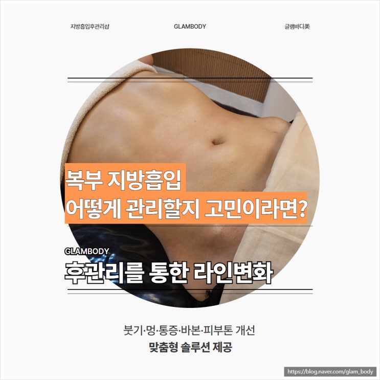  복부 지방흡입 후관리 멍붓기 사례