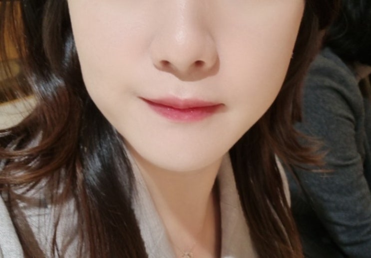  서현피부과 엑셀브이레이저 효과 후기