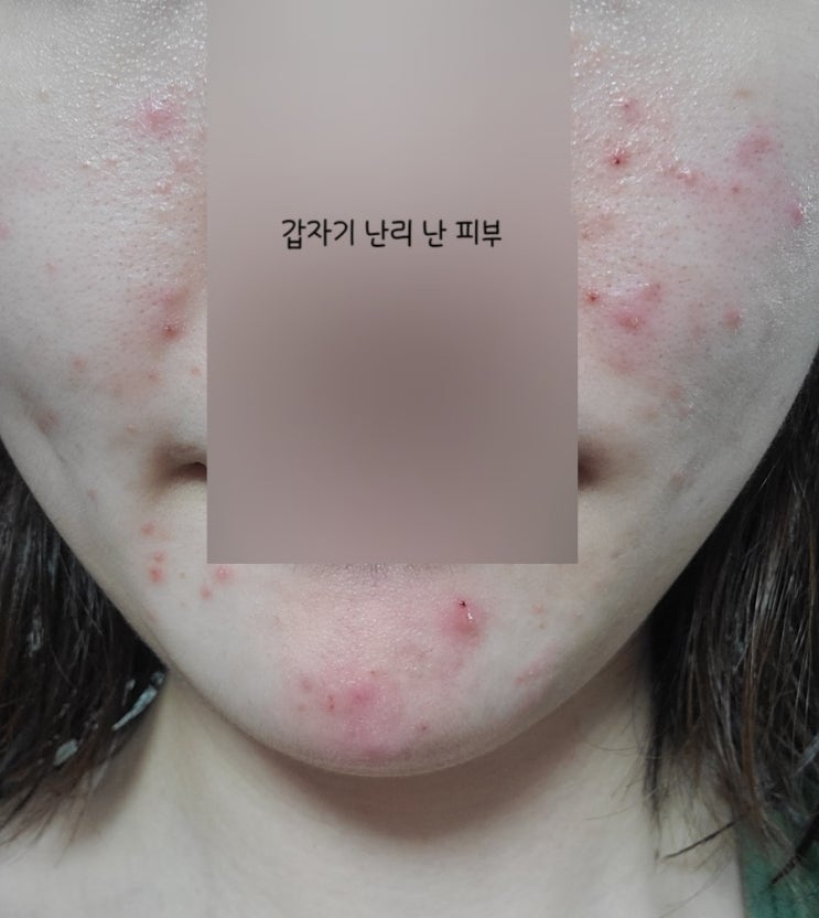  민감성 피부의 무알콜 토너 찐추천템 - 뮤신토너(비포 애프터 췤!)