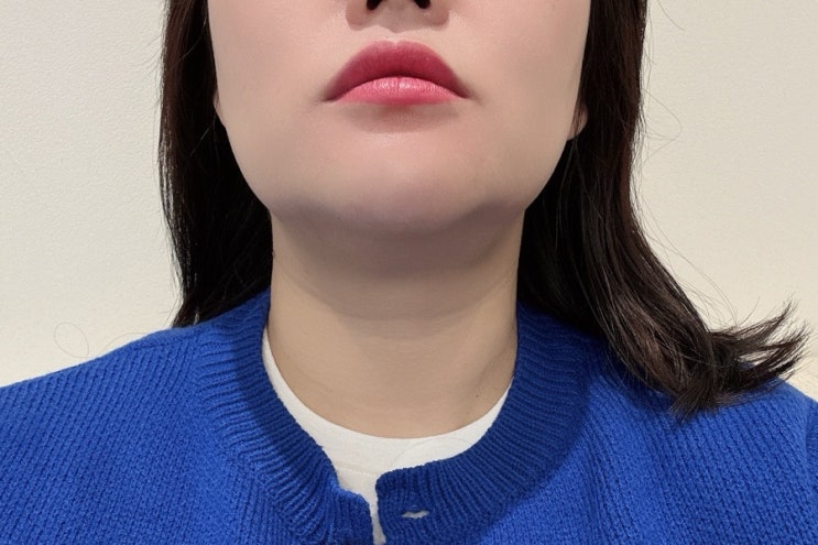 일산피부과에서 밴스슬림넥 승모근보톡스받고 직각어깨된 후기