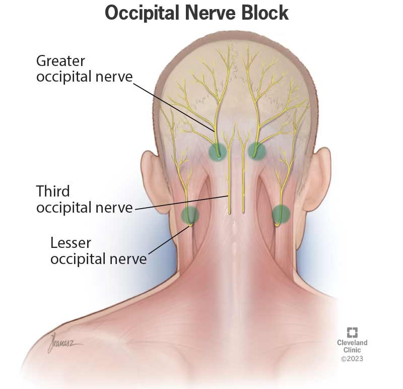 Occipital Nerve Block 후두신경차단술 : 네이버 블로그