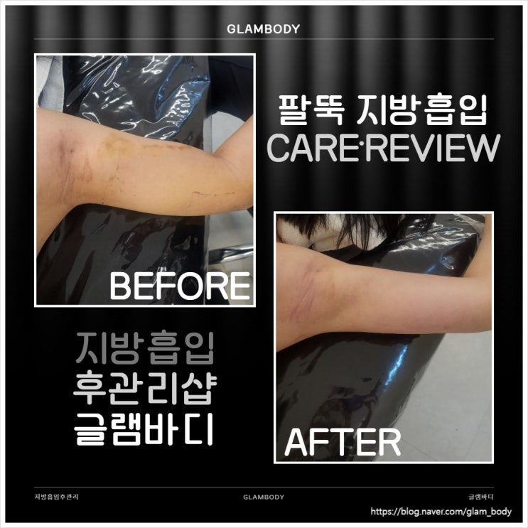 팔뚝 지방흡입 바이오본드.멍.붓기 관리 사례
