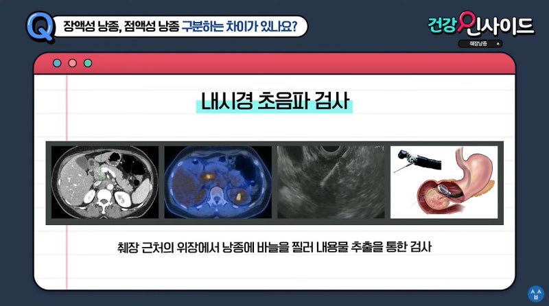 췌장에 물혹?! 췌장낭종에 관한 8가지 Q&A / 삼성서울병원 소화기내과 이규택 교수 : 네이버 블로그