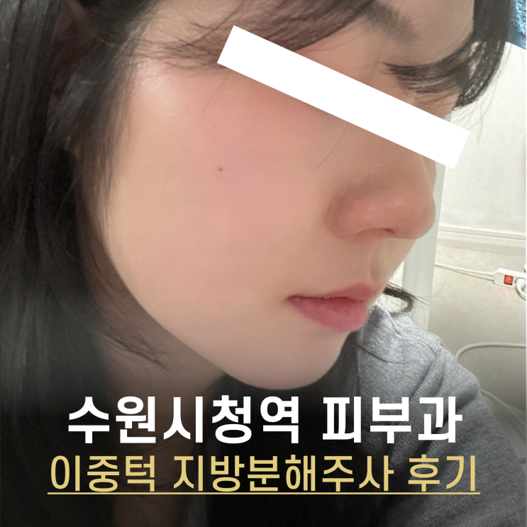  수원 피부과 이중턱 윤곽주사 솔직후기 +열흘 경과