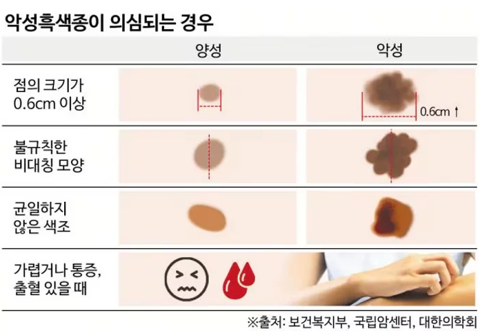 악성 흑색종: 역사, 원인, 증상, 생존율, 치료, 흔한 오해