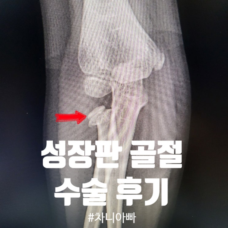  아이 팔 성장판 골절 수술 후 완치 후기