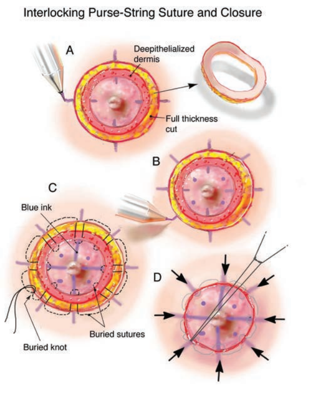 다양한 배꼽수술의 방법들을 알아보자.(1)-purse string suture : 네이버 블로그